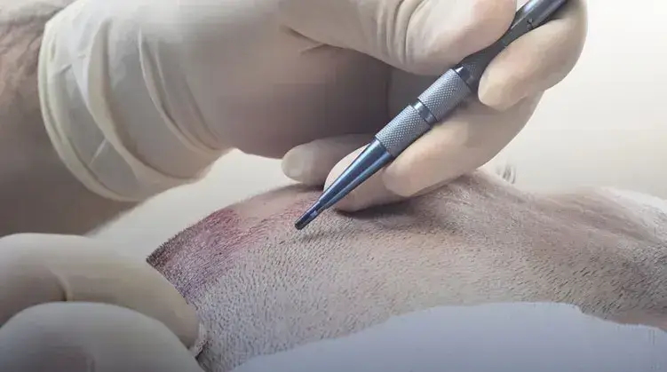 What is Sapphire Hair Transplantation?