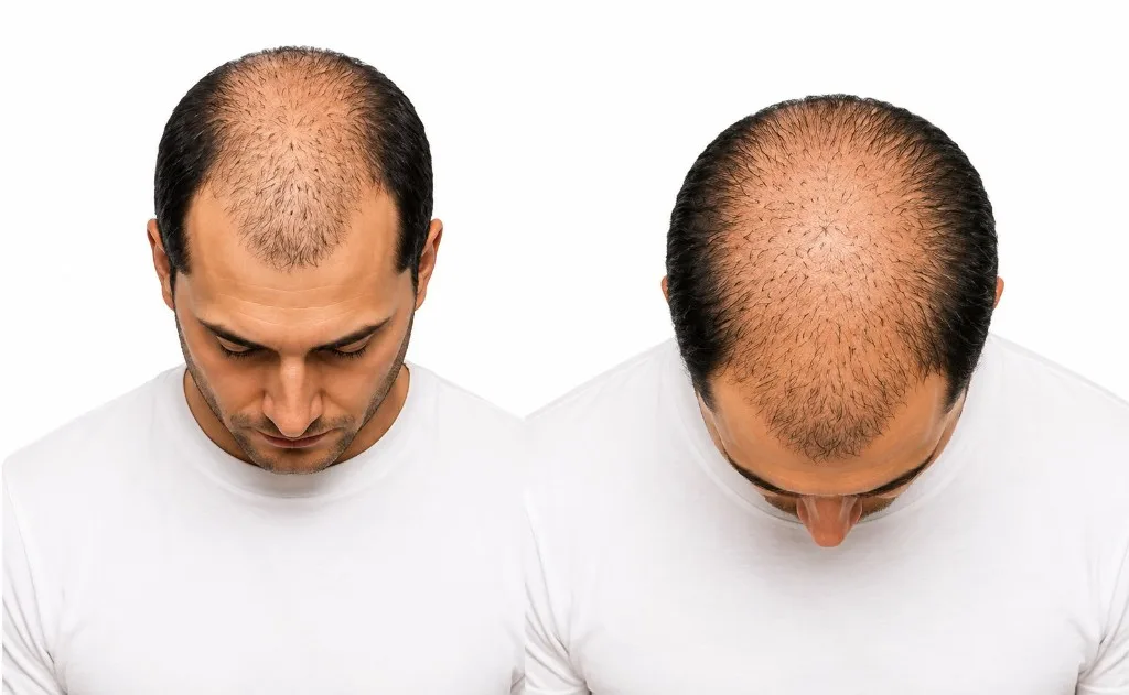 Hair pattern A