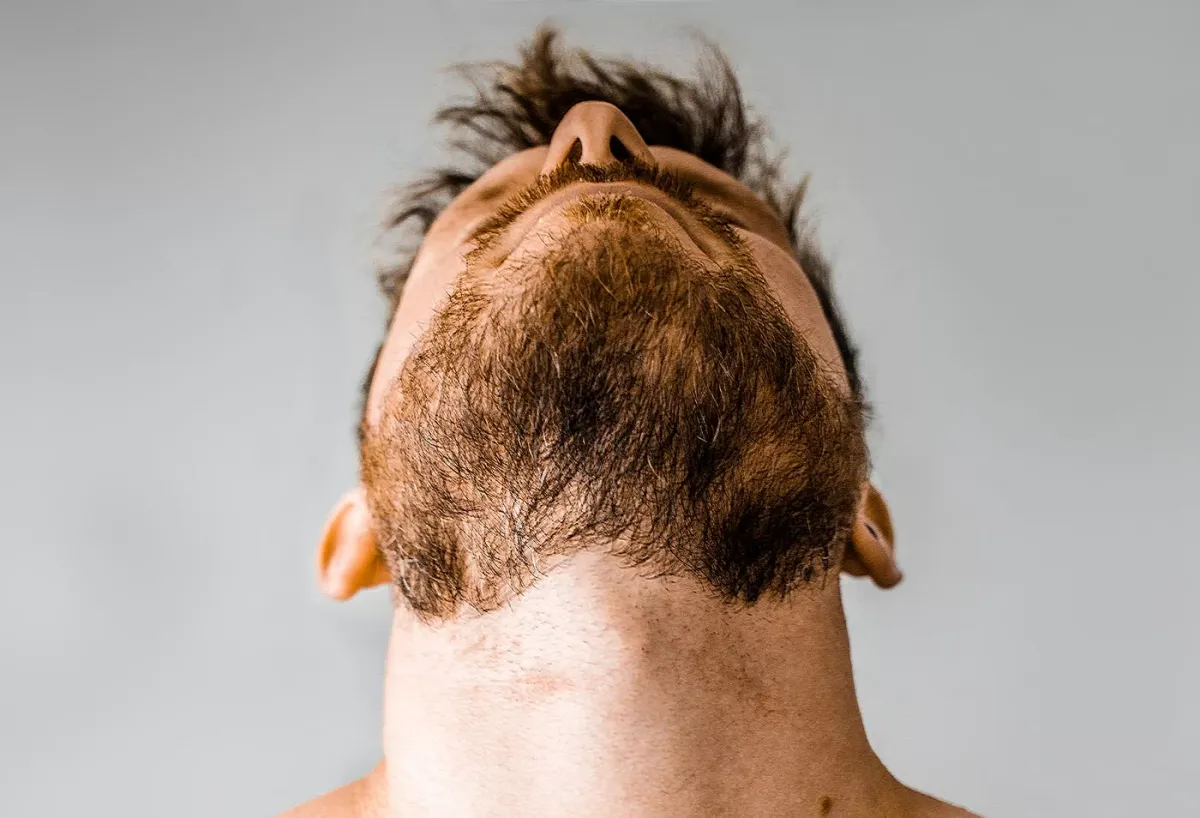 Rediscover Confidence with a Natural Beard: Premier Beard Transplant Services in Turkey