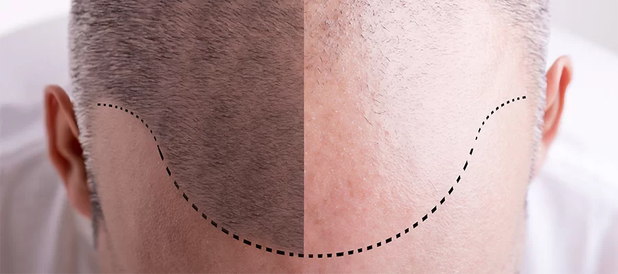 Implantation phase
