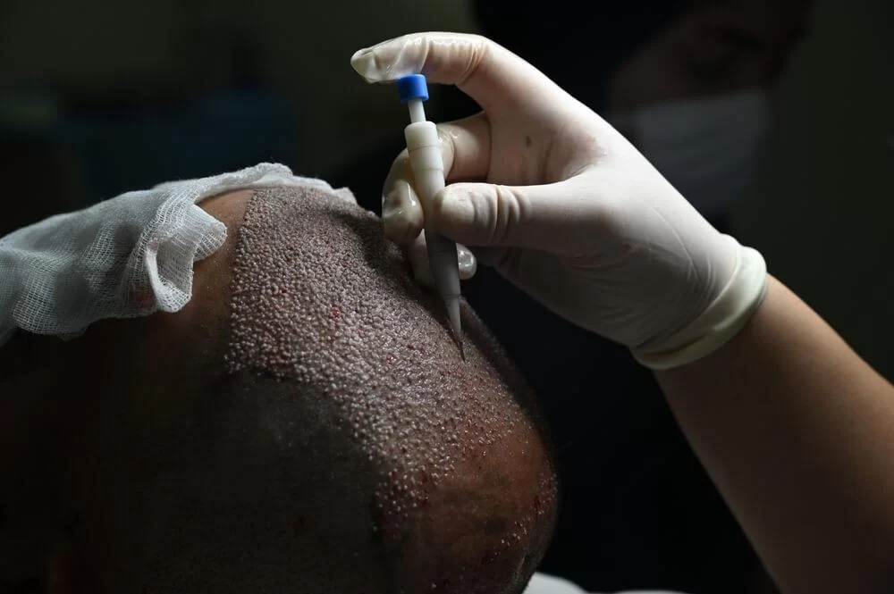 DHI Hair Transplant Turkey