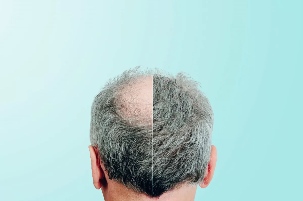 Rediscover Your Confidence with EsteMark Premier FUE Hair Transplant