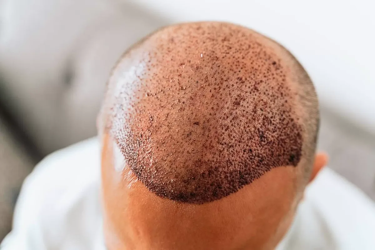 The Science Behind FUE Hair Transplant
