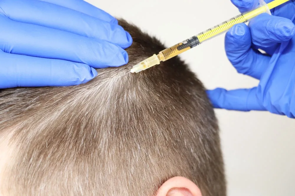 Is Long Hair Therapy an Alternative to Hair Transplantation?